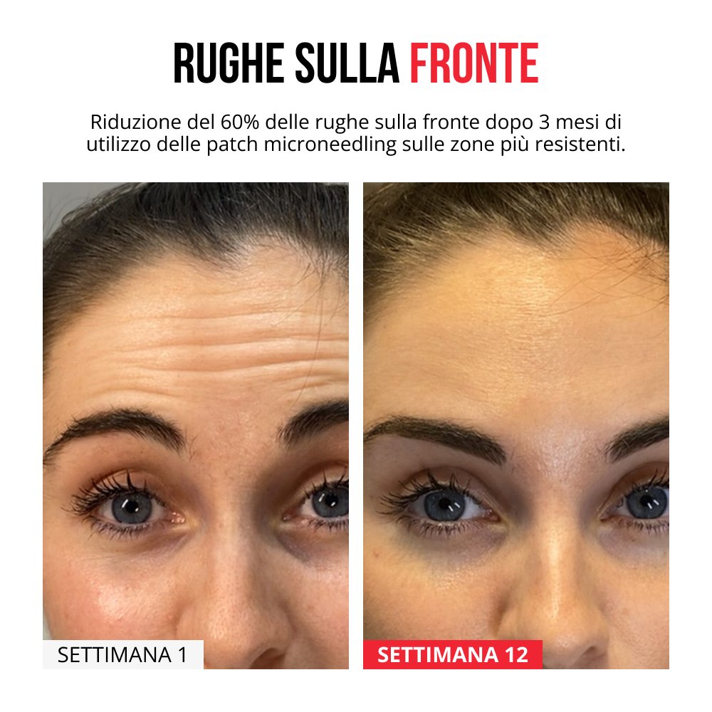 Cerotti innovativi con micro-aghi